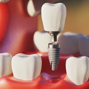 Digital image of a dental implant and its parts