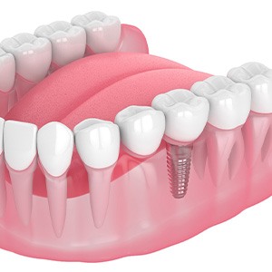 Illustration of single dental implant