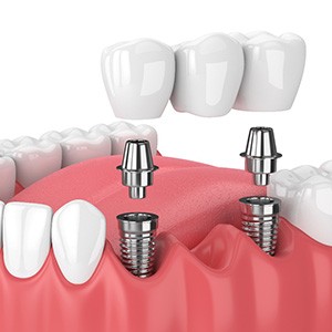 Illustration of implant bridge