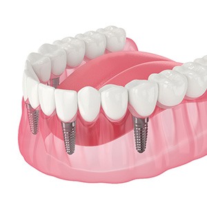 Illustration of implant denture
