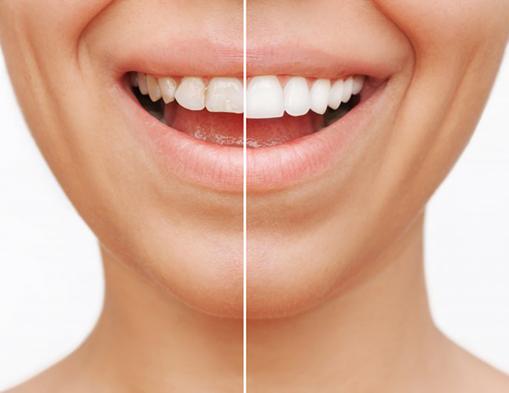Before and after veneers