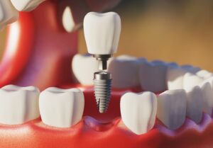 a single dental implant